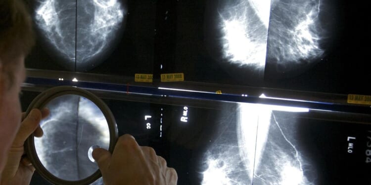 Mammograms should begin at 40 to address rising breast cancer rates at younger ages, panel says