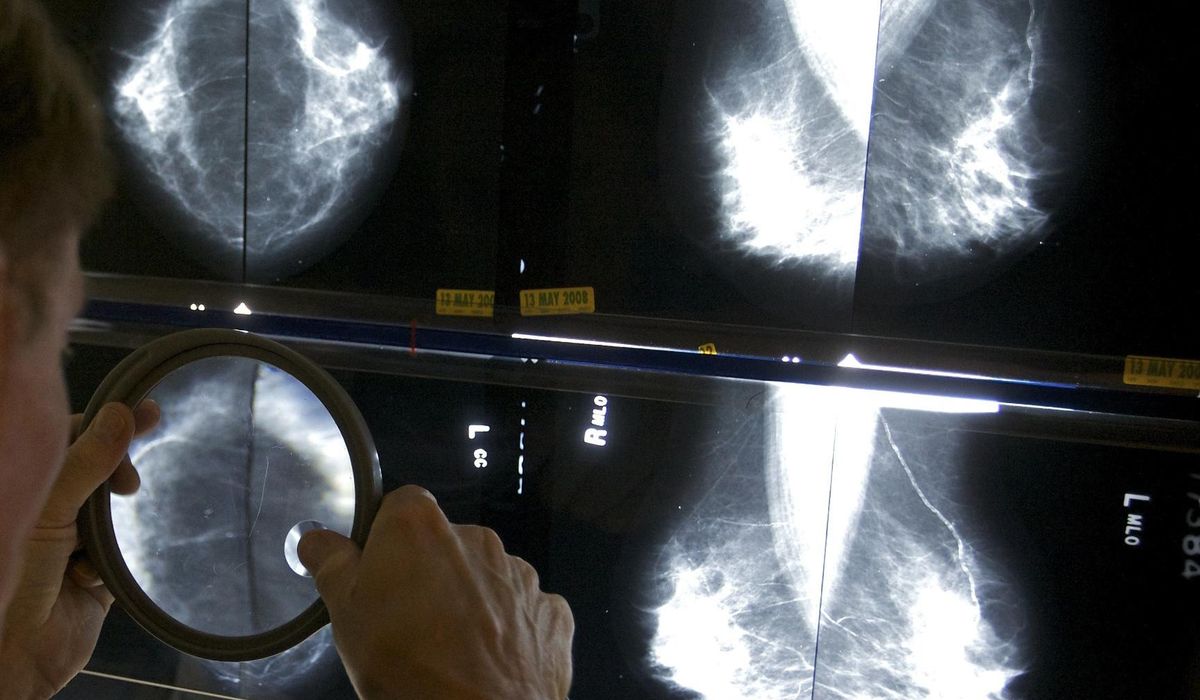 Mammograms should begin at 40 to address rising breast cancer rates at younger ages, panel says