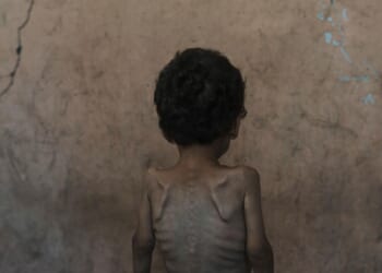 Nearly 55,000 children in Gaza under age 5 may be acutely malnourished, a new U.N. study finds