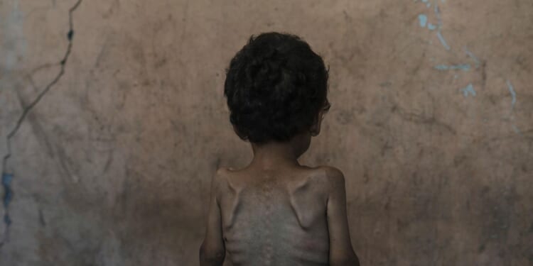 Nearly 55,000 children in Gaza under age 5 may be acutely malnourished, a new U.N. study finds