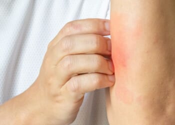 Ivermectin is now available in a cream that can be used to treat a variety of skin problems.