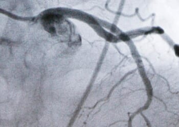 Beyond statins: Experimental cholesterol-lowering pill may offer new option for millions