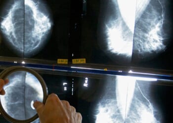 When should you get a mammogram? Conflicting advice makes it hard to know