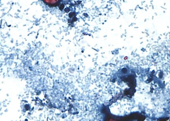 Outbreak of diarrhea-causing parasite grows to more than 1,000 cases