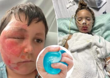 Children have been severely burned by following a popular TikTok trend.