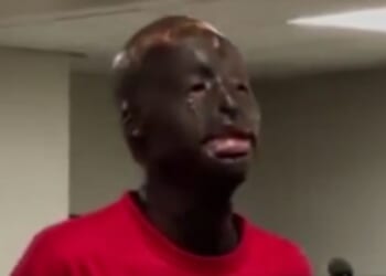 Zaquan Shaquez Jamison appears in court after being charged with murder, but he claims it is impossible for him to be the killer because his burns do not allow his hand to bend to pull the trigger.