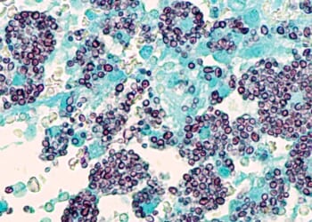 Fungal infection in Tennessee leaves 1 dead, at least 30 infected