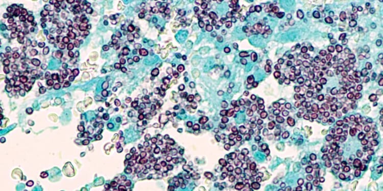 Fungal infection in Tennessee leaves 1 dead, at least 30 infected