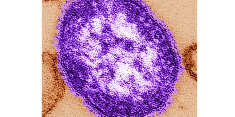 CDC lists first U.S. measles death of 2026 on website, while Pennsylvania reports four deaths