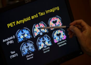 Want to lower your risk of dementia? It doesn't involve a blood test